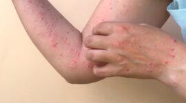 Ilustrasi seseorang yang terjangkit monkeypox. (Foto: Ist)